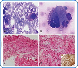 Fine Needle Aspiration