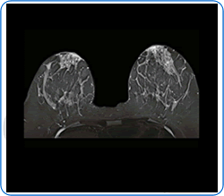 Breast MRI scan image