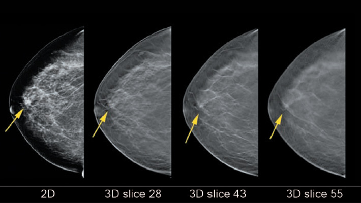Tomosynthesis mammogram images